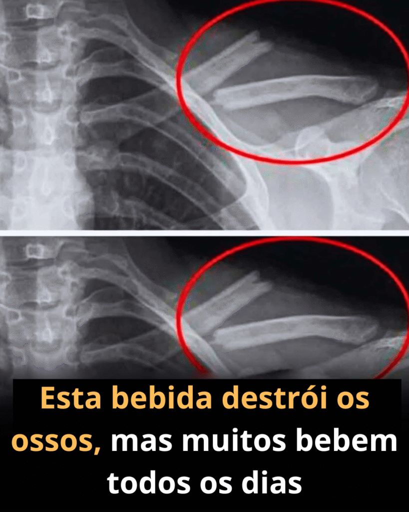 Este líquido destrói os ossos? Entenda o impacto dos refrigerantes